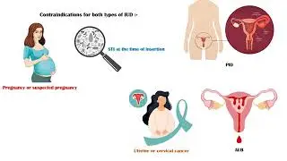 Intra Uterine Contraceptive Device (IUCD/IUD) - Types, Uses, Contraindications, & Complications