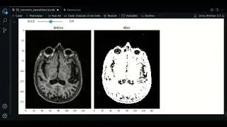 2.4 - Denoise, Blurring, Thresholding | SimpleITK - Course MRI preprocessing with Python