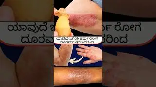 ಇಸುಬು ಹುಳುಕಡ್ಡಿ ಎಲ್ಲಾ ಚರ್ಮರೋಗ ಗುಣವಾಗಲು ಮದ್ದು|#manemaddu #skininfection #youtubers #shortfeed
