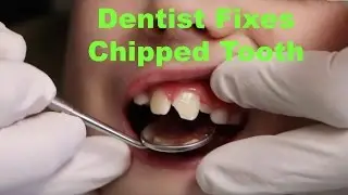 Child gets chipped tooth fixed - Murfreesboro Cosmetic Dentist