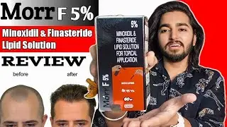 Morr F 5% Minoxidil & Finasteride Lipid Solution Review After Use | This iSahil