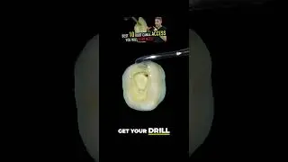 Преображение улыбок 😁 Освоение доступа к нижним молярам! 🦷