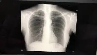 2View Chest Trigger SBCC Radiology Program Taylor G Fall 2019