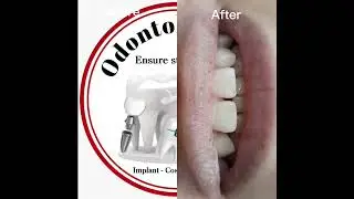 TOOTH FILLING FOR FRACTURED INCISOR EDGE , TOOTH COLR COSMETIC FILLING,  COMPOSITE FILLING
