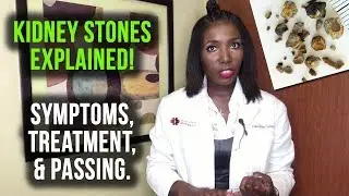 Kidney Stones Symptoms and Treatment [2020]