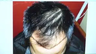 FUE Asian Hairline Hair Transplant Surgery Before After Dr. Diep  