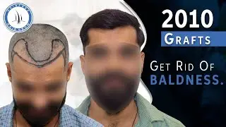 Advanced BIO-FUE Without Pain Best Hair Transplant Result Journey with Comb Test @HairfreeHairgrow