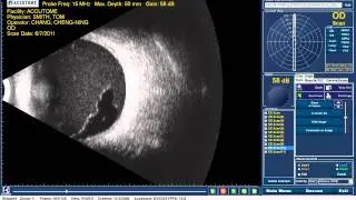 Accutome B-scan Plus - Vitreous Hemorrhage