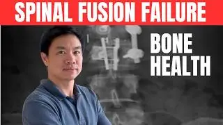 Why Bone Health Matters for Spinal Fusion