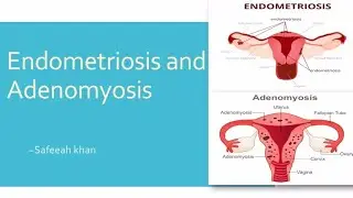 ENDOMETRIOSIS AND ADENOMYOSIS DC DUTTA
