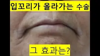 입꼬리 올림술과 인중세로주름 동시교정의 놀라운 결과! #입꼬리리프팅 #입술고양이주름 #연세자연미 #신촌성형외과
