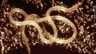 Man Dies After Tapeworm Inside Him Gets Cancer - Newsy