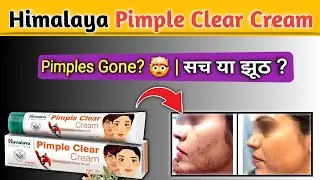 himalaya pimple clear cream || pimple removal || acne cream