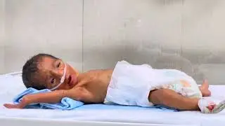 Premature 7-Month Gestational Baby with Extreme Low Birth Weight | Royal Nursery Unit