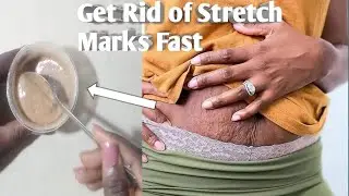 How to Remove Stretch Marks Permanently: World Best Remedy to Get Rid of Stretch Marks Fast