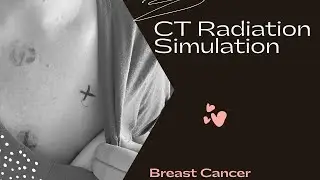 CT Simulation for Radiation Therapy