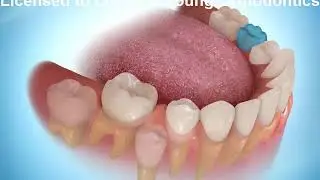 Lower Orthodontic Space Maintainer Lustig & Young Orthodontics