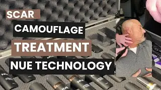 Scar Camouflage Treatment
