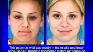 How to Fix a Twisted Nose by Rhinoplasty Specialist Dr. Becker