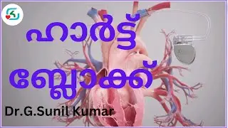Heart block and Pacemaker, with animations. By. Dr.G.Sunil Kumar MBBS, DPH, PGDNIC ( cardiology )