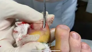 Ingrown Toenail Removed - Phenol and Alcohol Matricectomy with Dr. Joseph M. LaConte D.P.M.
