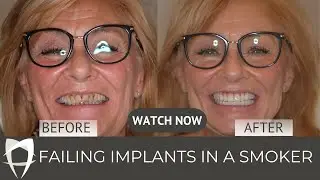 21. Failing implants in a smoker. What are the options?
