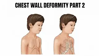 CHEST WALL DEFORMITY | PECTUS CARINATUM | POLAND SYNDROME | ECTOPIA CORDIS 