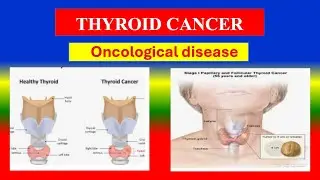THYROID CANCER -Types, Risk Factors & Management | Complete Medical Guide signs and  symptoms.