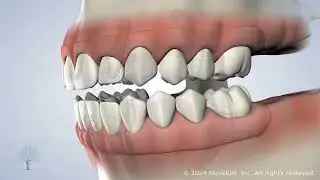 Full-Arch Restoration | Raleigh Oral Surgery & Dental Implants