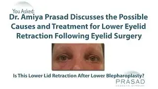The Causes of Pulled Down Eyelids After Surgery, from Temporary to Needing an Oculofacial Specialist