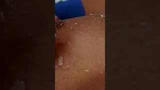 ASMR foot peeling socks: Today remove Feet socks - Satisfying Pimple Popping