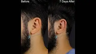 Otoplasty Surgery | Before And 7 Days After