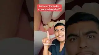 Asi se colocan las coronas dentales? #brackets #foreigntraineddentist #mexico #dentista