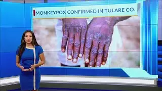 What can you do to avoid monkeypox?