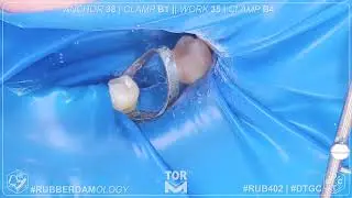 #rubberdamology #dtgc #apokin  #tooth 35 #torvm #8k #8kdcv V2 EN 019