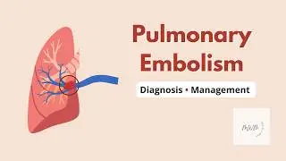 Pulmonary Embolism (Part 2) | Diagnosis, Management, Anticoagulation & Reperfusion therapy