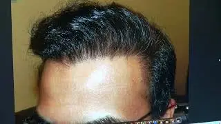 Hairline Restoration Surgery: Transformative Results! | MHTA Clinic