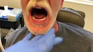Lower Suction Dentures&mdash; Amazing Fit!