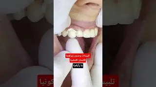 تلبيسات وجسور زيركونيا للاسنان الامامية