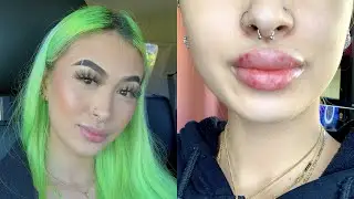 LIP FILLER VLOG | 2ND SYRINGE