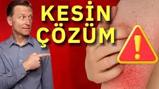 Keratosis Pilaris (Tavuk Derisi G&ouml;r&uuml;n&uuml;m&uuml;) İ&ccedil;in M&uuml;kemmel &Ccedil;&ouml;z&uuml;m | Dr. Berg T&uuml;rk&ccedil;e