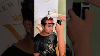 Hair Transplantation | Best in Bangalore #hairtransplantation #hairtransplant #bangalore #shorts