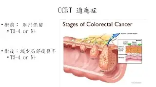 什麼是直腸癌同步放化療(CCRT)?-2