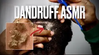 Dandruff Scratching ASMR | Removing Big Flakes From My Locs #dandruffremovalasmr #dreadlocksdandruff