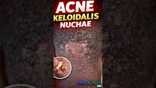 Razor Bumps or Borga&rsquo;s Disease?? ACNE KELOIDALIS NUCHAE #subscribe #menshealth #dermatology