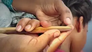 million of lice popping you wont believe this #pls #share #satisfying