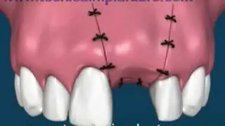 gbr e impianto in un dente singolo.flv