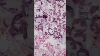 Psammoma Bodies - Pathology #shorts