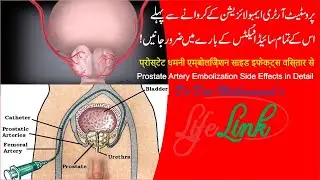 Prostate Artery Embolization Side Effects in Detail