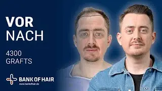 Haartransplantation Vorher Nachher - BANK OF HAIR - Haartransplantation Klinik - T&uuml;rkei ( Istanbul )